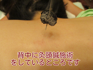 背中に灸頭鍼施術をしているところです
