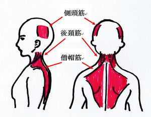 緊張型頭痛の起こる筋肉