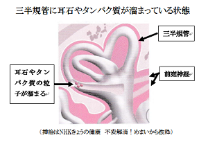 三半規管に耳石やタンパク質が溜まっている状態