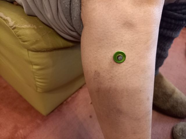 足三里への灸