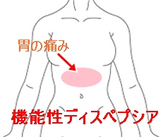 胃の痛み　機能性ディスペプシア