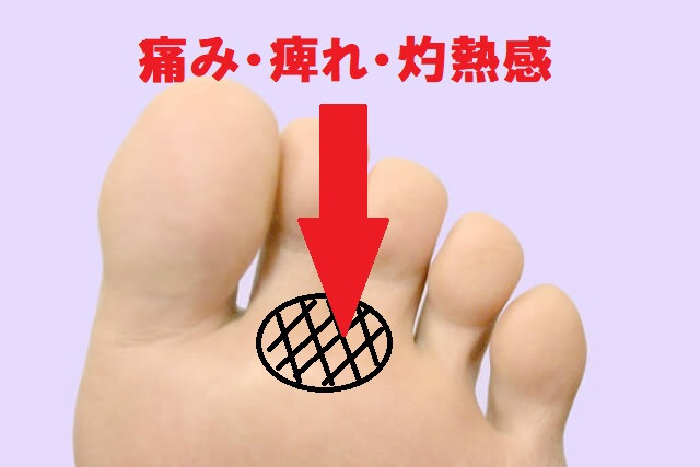 モートン病の痛みの部位