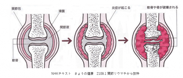 滑膜の炎症