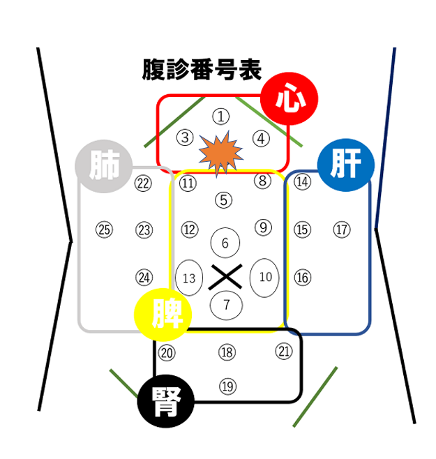 鳩尾下2.5cmあたりに圧痛