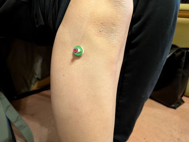 足三里へのお灸