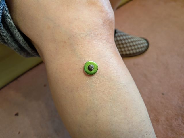 足三里へのお灸