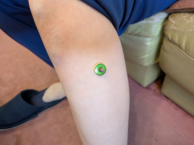 足三里へのお灸