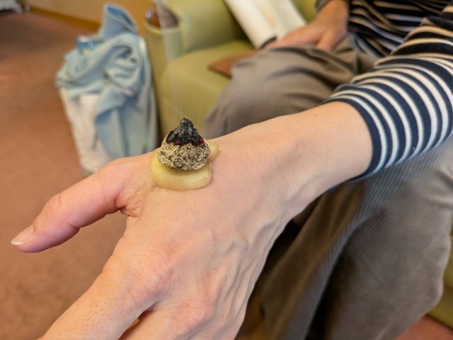 ショウガを使った隔物灸