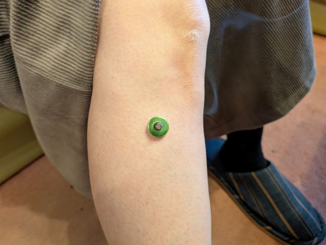 足三里へのお灸